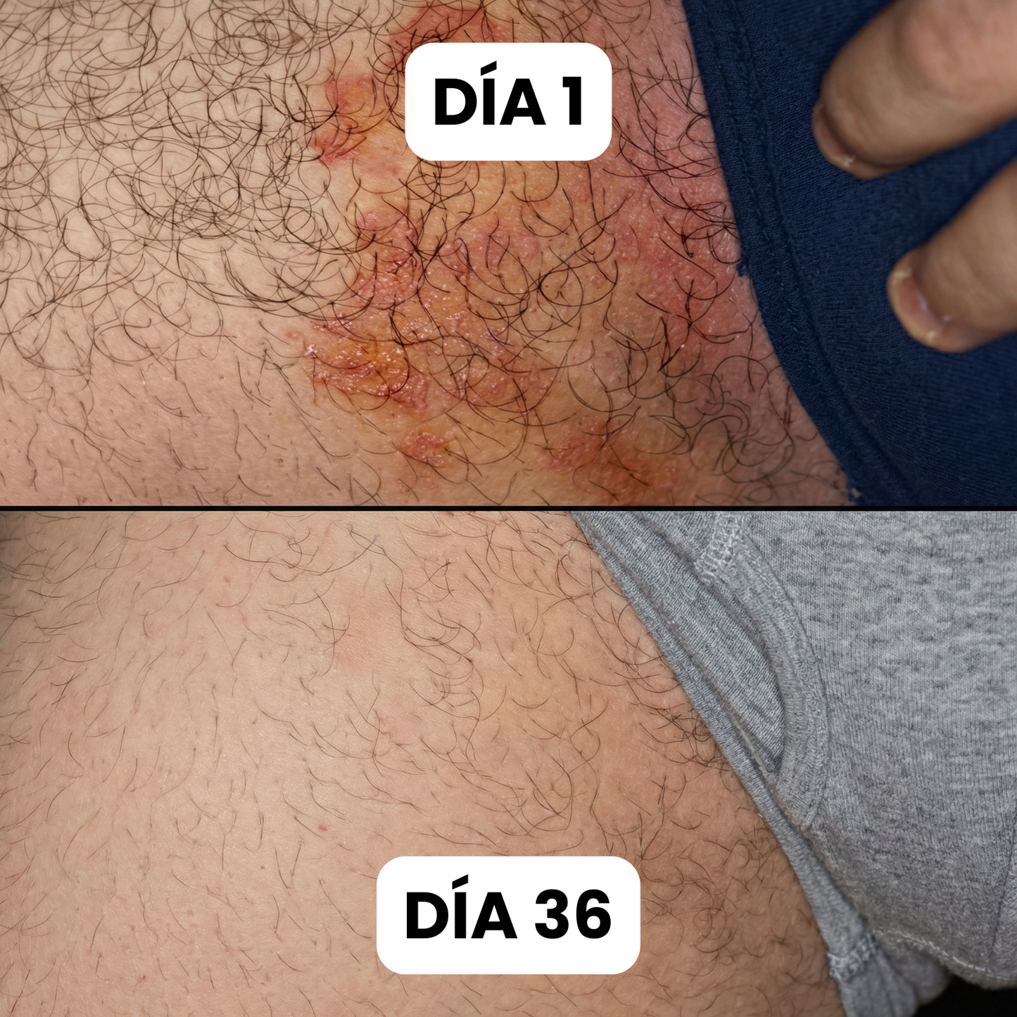 Bartilia® - Crema de Cuidado Para los Pliegues de la Piel