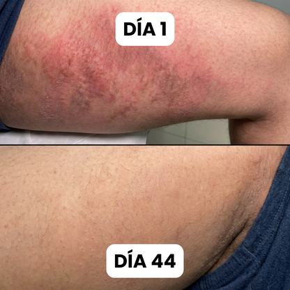 Bartilia® - Crema de Cuidado Para los Pliegues de la Piel