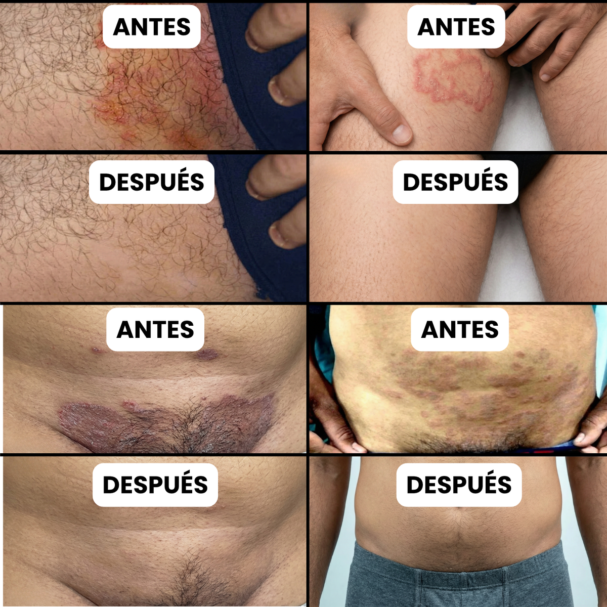 Crema AntiInflamatoria Para los Pliegues de la Piel