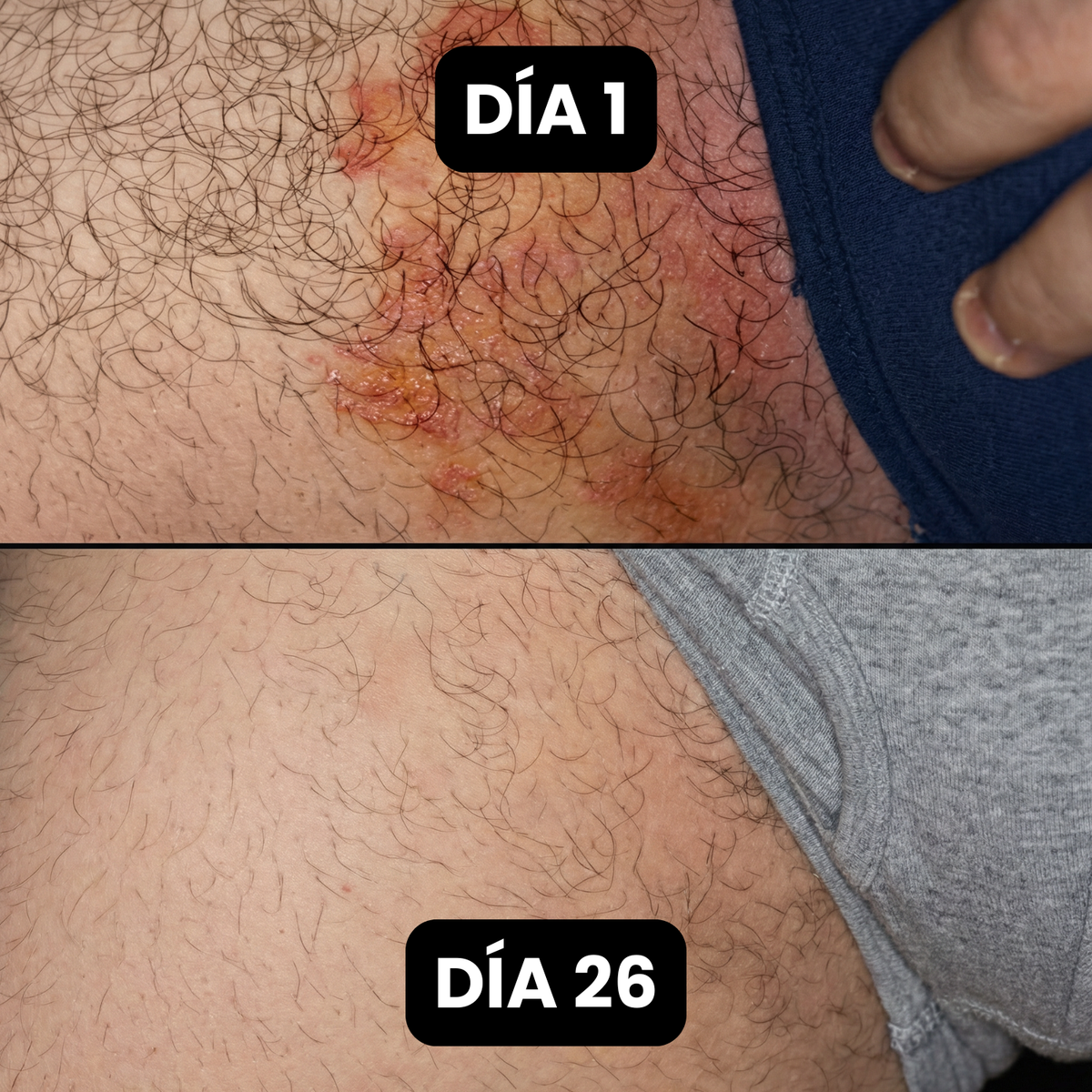 Jabón Antifúngico Bartilia®