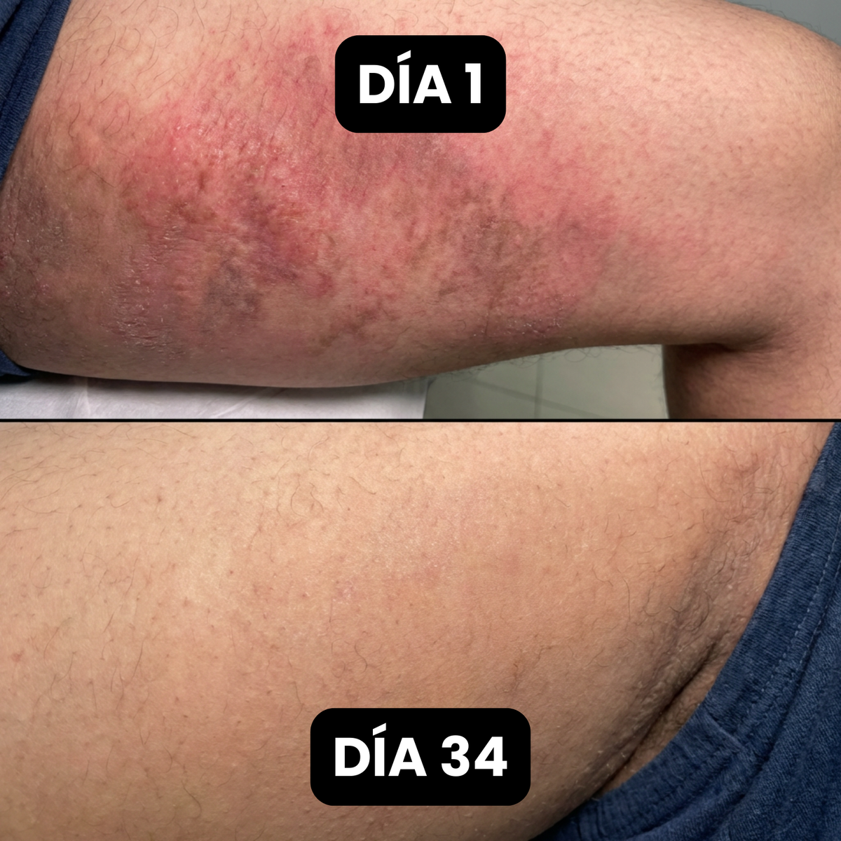 Jabón Antifúngico Bartilia®